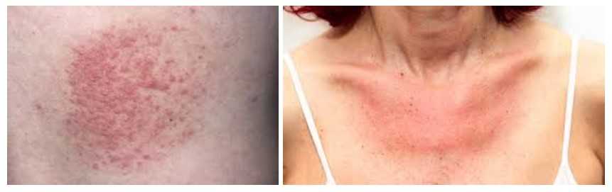 сонячні дерматити або алергія на сонце