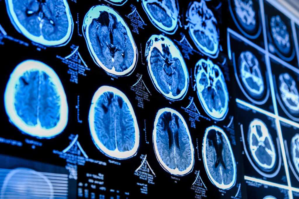 Знакове дослідження Альцгеймера та наукова доброчесність